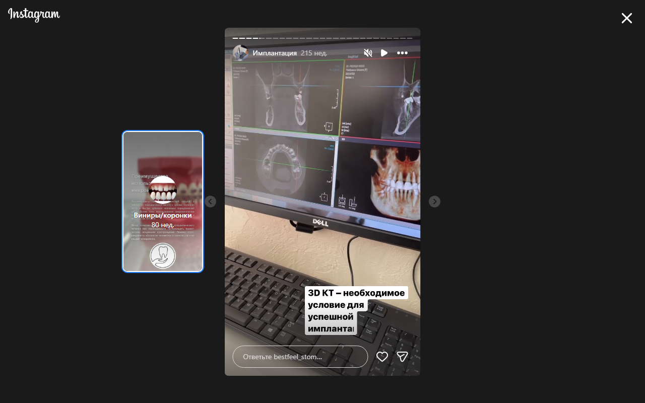 Имплантация зубов с 3D КТ — Bestfeel Dental