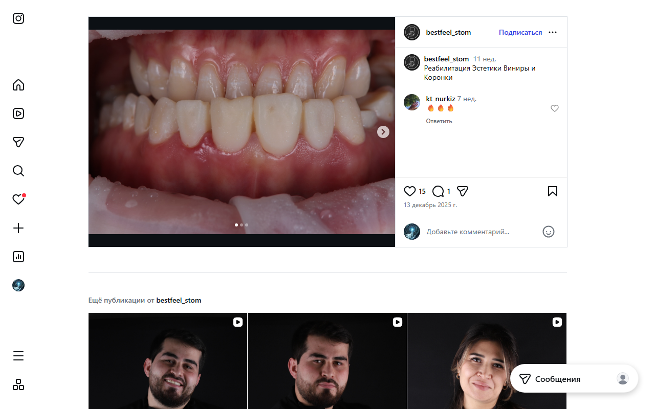 Виниры и коронки — реабилитация эстетики