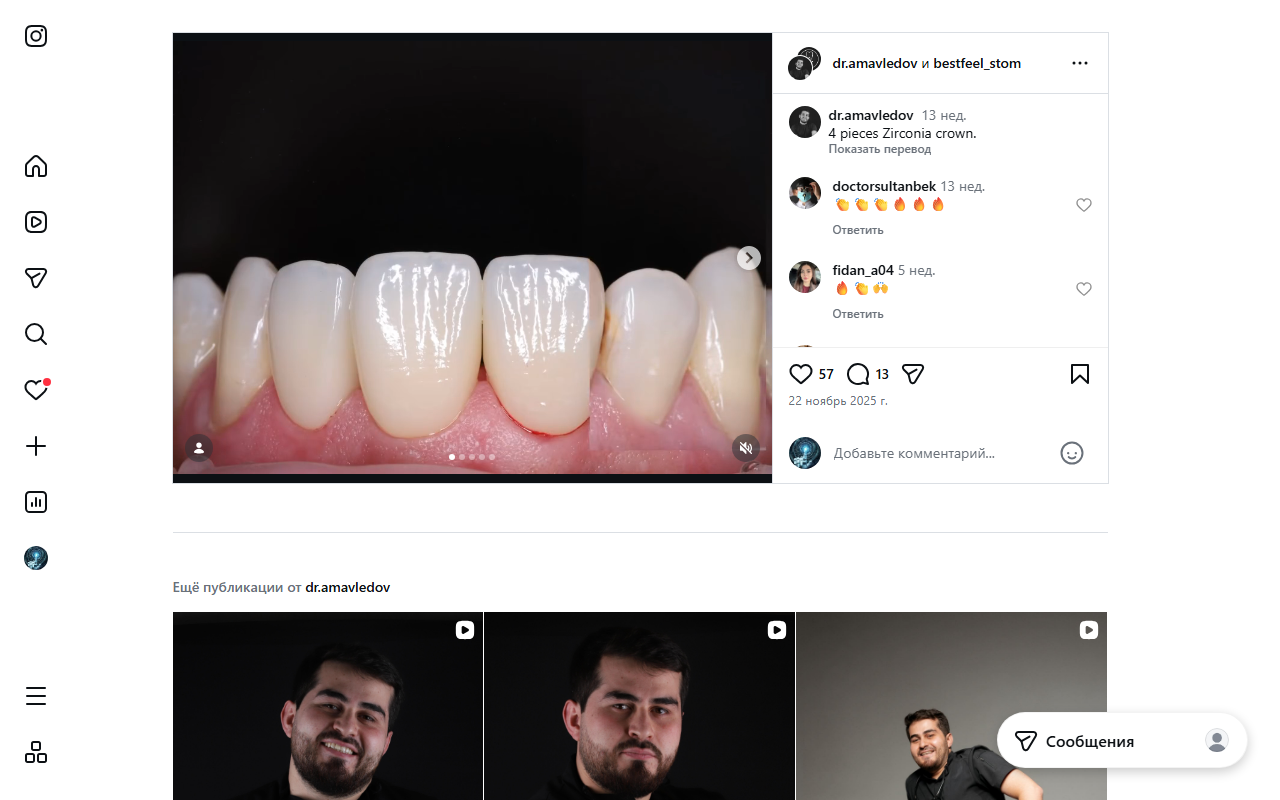 4 циркониевые коронки — результат